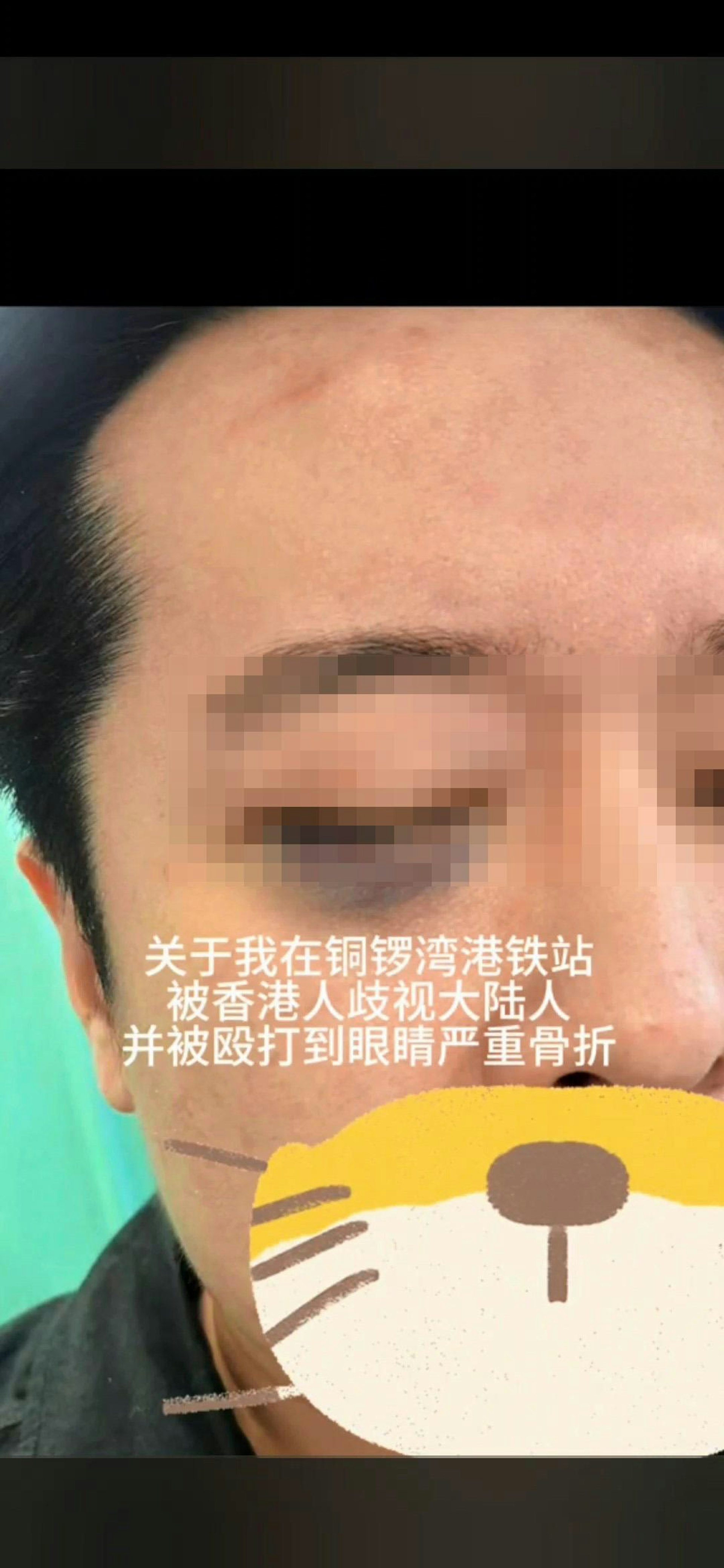 有在香港工作的內地男子在抖音稱,在港鐵銅鑼灣站被1對香港男女歧視侮辱被毆打,眼眶及鼻骨嚴重骨折、右臉麻木。(抖音影片截圖)