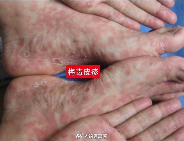 梅毒示意圖。（微博）