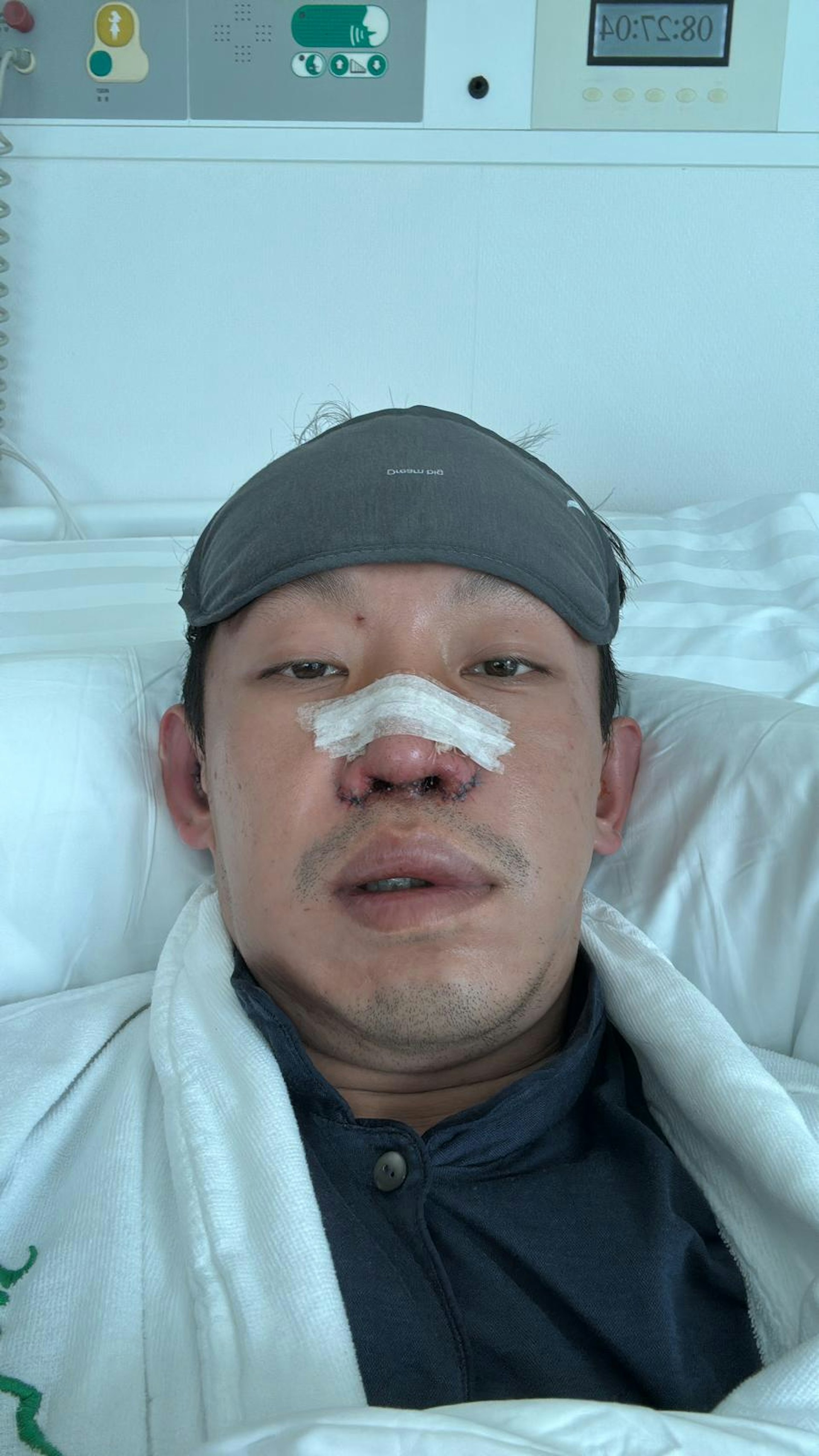 MOISELLE太子爺陳柏熹(Harris)遭遇嚴重意外而毀容,經歷了超過兩年才康復。(受訪者提供) MOISELLE太子爺陳柏熹(Harris)遭遇嚴重意外而毀容,經歷了超過兩年才康復。(受訪者提供)