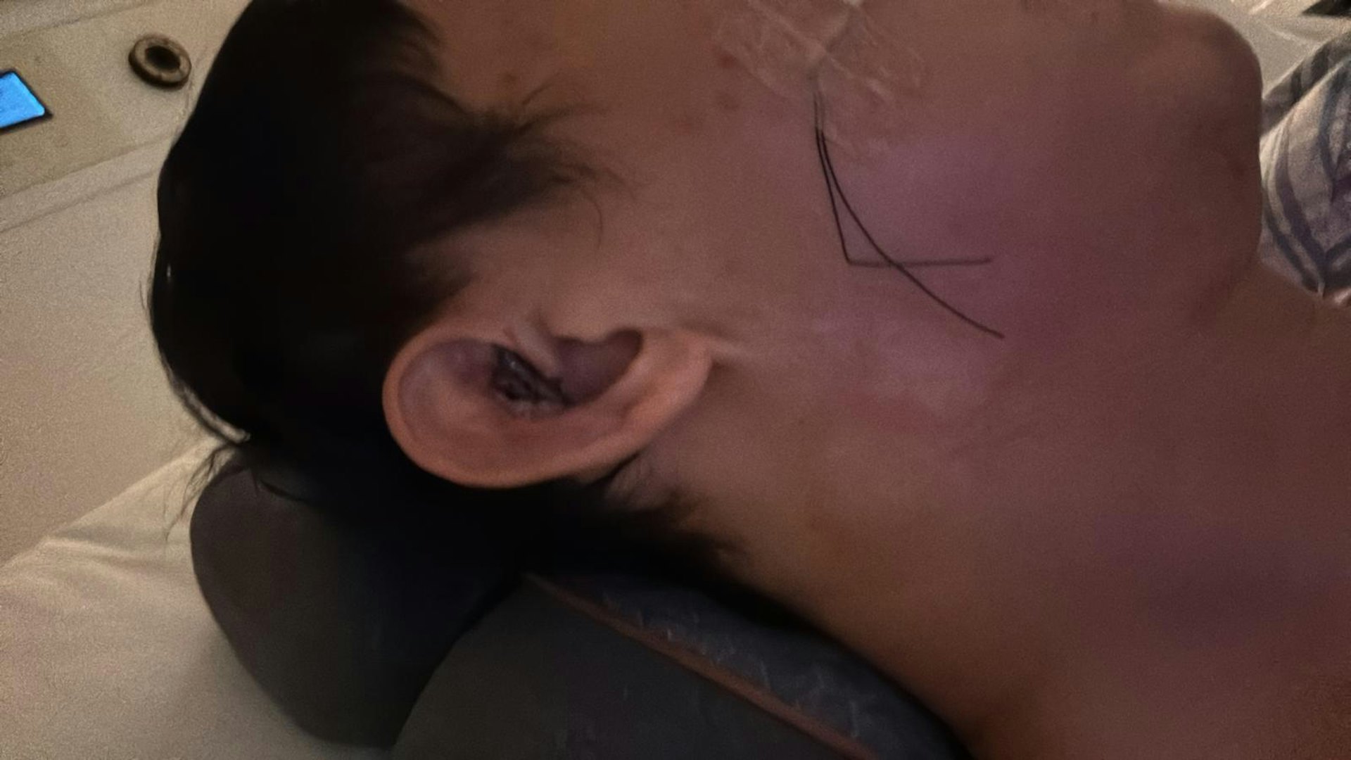 MOISELLE太子爺陳柏熹(Harris)遭遇嚴重意外而毀容,經歷了超過兩年才康復。(受訪者提供) MOISELLE太子爺陳柏熹(Harris)遭遇嚴重意外而毀容,經歷了超過兩年才康復。(受訪者提供)