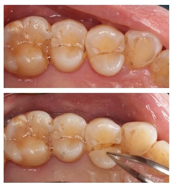 當牙齒出現裂縫（下圖），細菌會隨裂縫入侵，容易引致感染發炎。