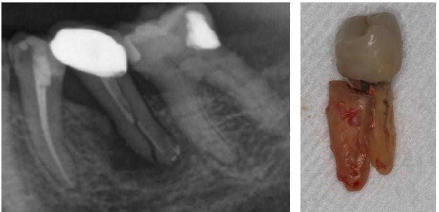 當裂紋已裂到牙齒深處（左圖），情況便不容樂觀，牙醫會與病人討論牙齒的去留。