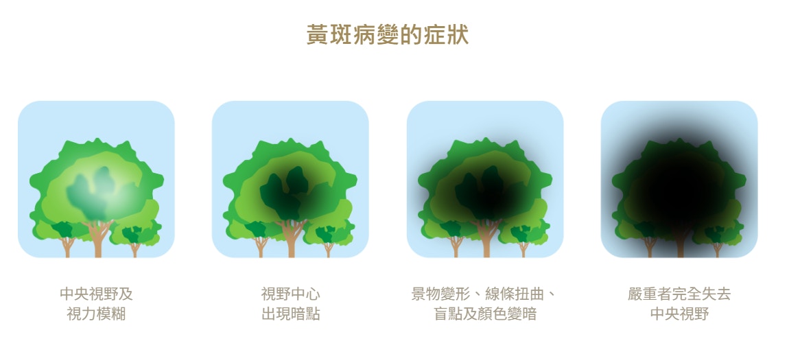 黃斑病變影響視力，嚴重者會導致視力完全喪失。