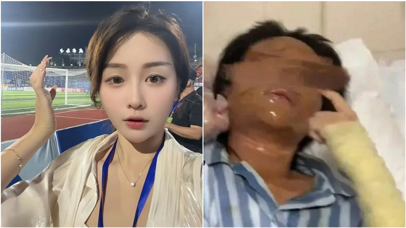 湖南女主播拒愛狂迷遭假包裹炸傷毀容 此前被潑強酸、車軚遭拮破