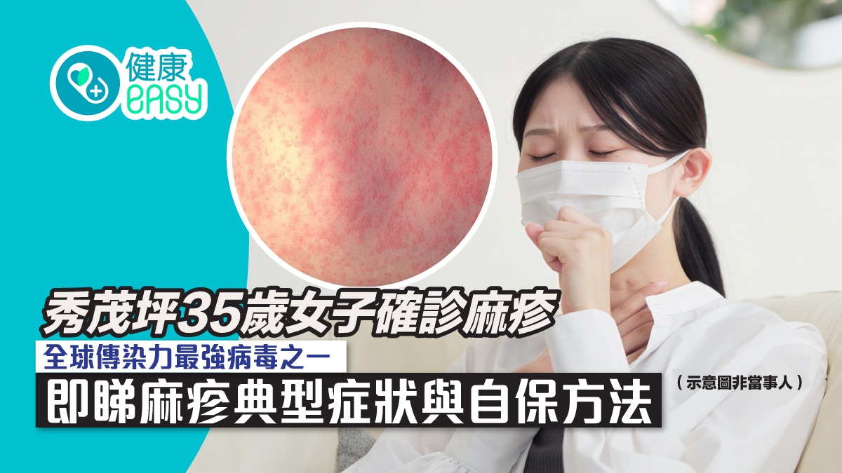 秀茂坪35歲女確診麻疹