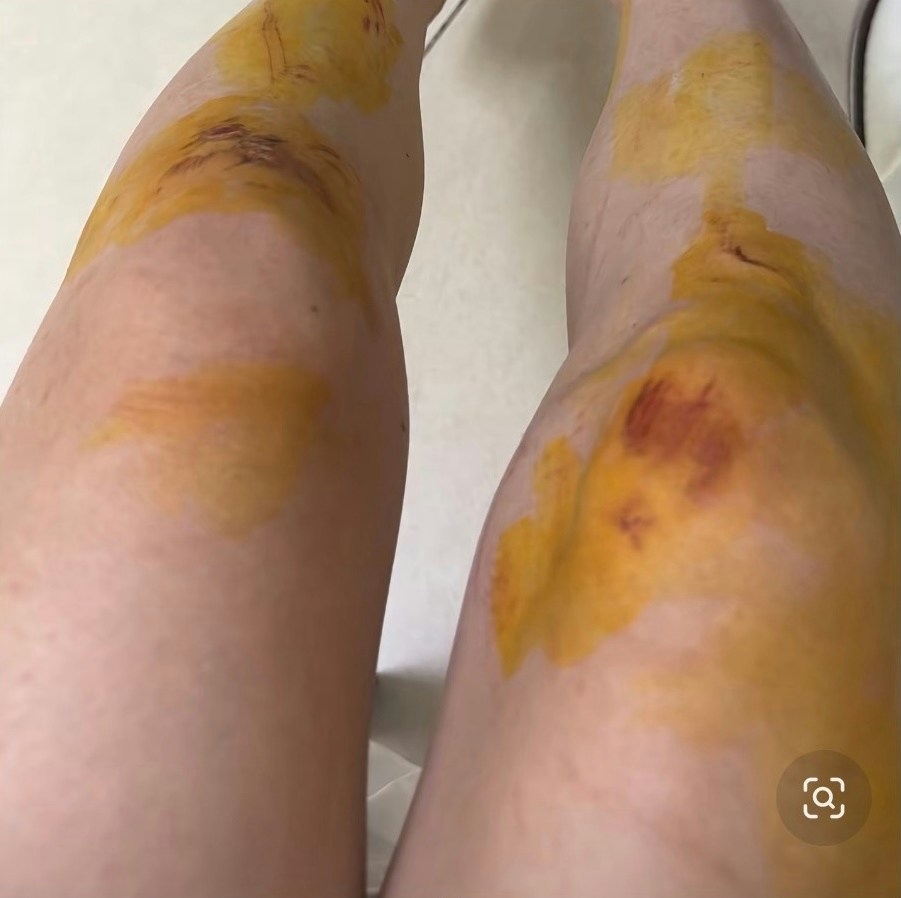 女事主双脚有多处伤口。(微博)