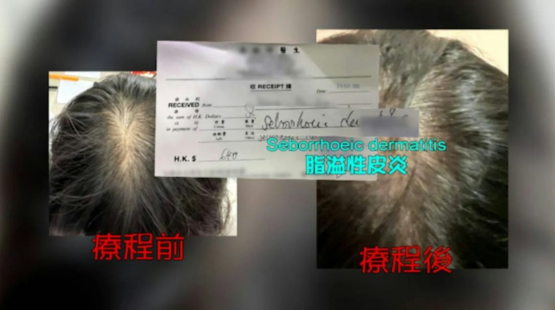 當事人發現頭皮在接受治療數日後,出現劇烈痕癢,髮量變得比以往更加稀疏,求醫後被確診患上脂溢性皮炎。
