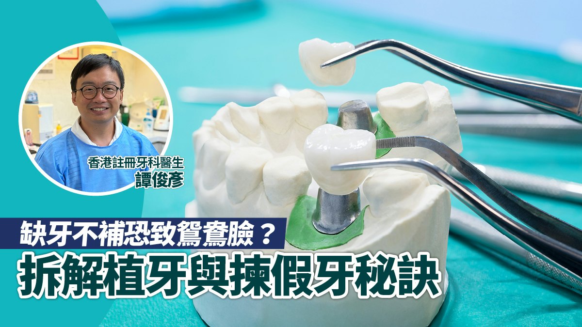 缺牙不補恐致鴛鴦臉?譚俊彥牙醫拆解植牙與揀假牙秘訣