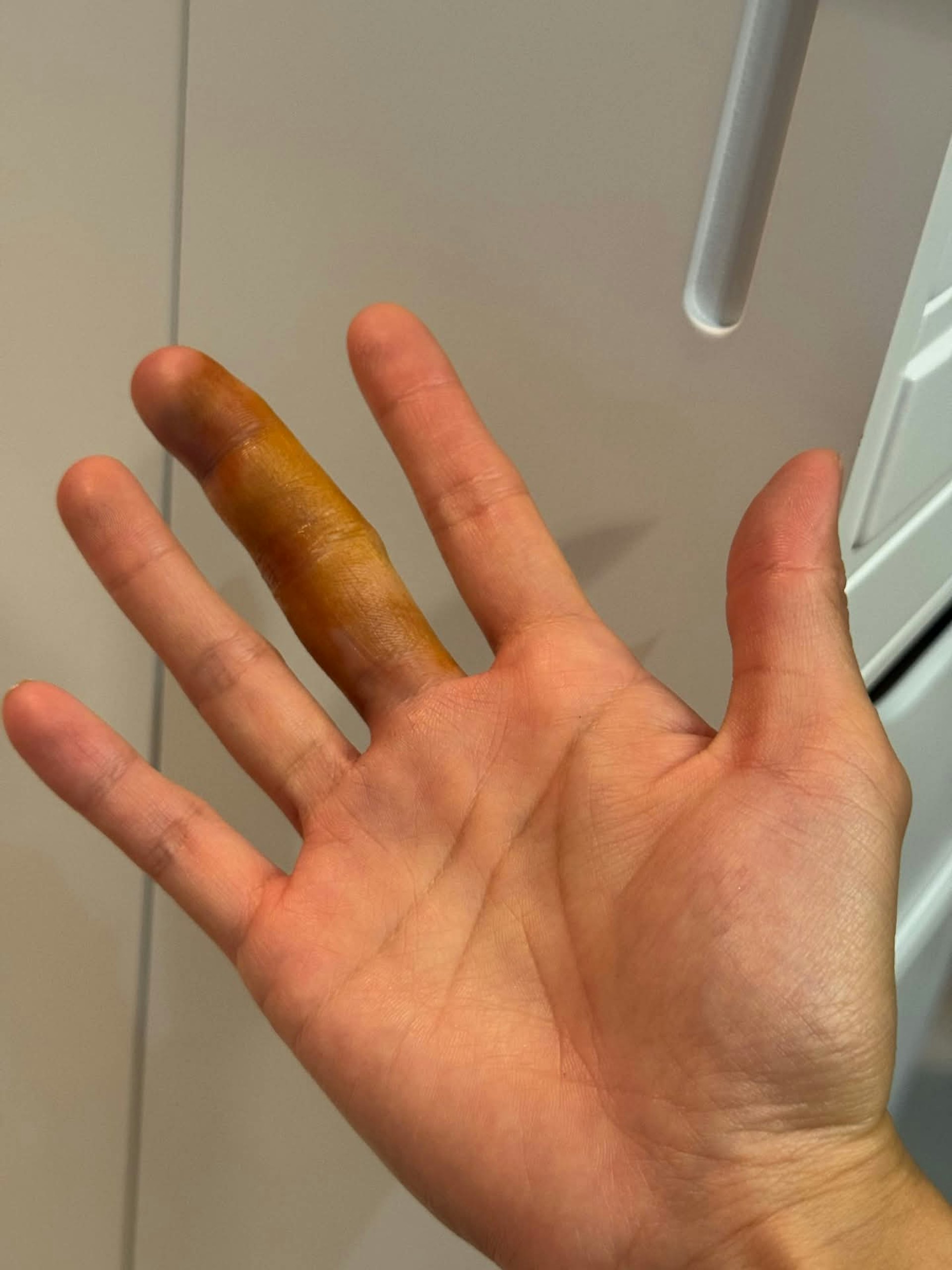 有女受害人在网上分享经过,「膝头哥内侧被喷咗啲不明液体feel到湿左」,其后与疑犯纠缠时,伤及右手手指。(Threads h0i.2)