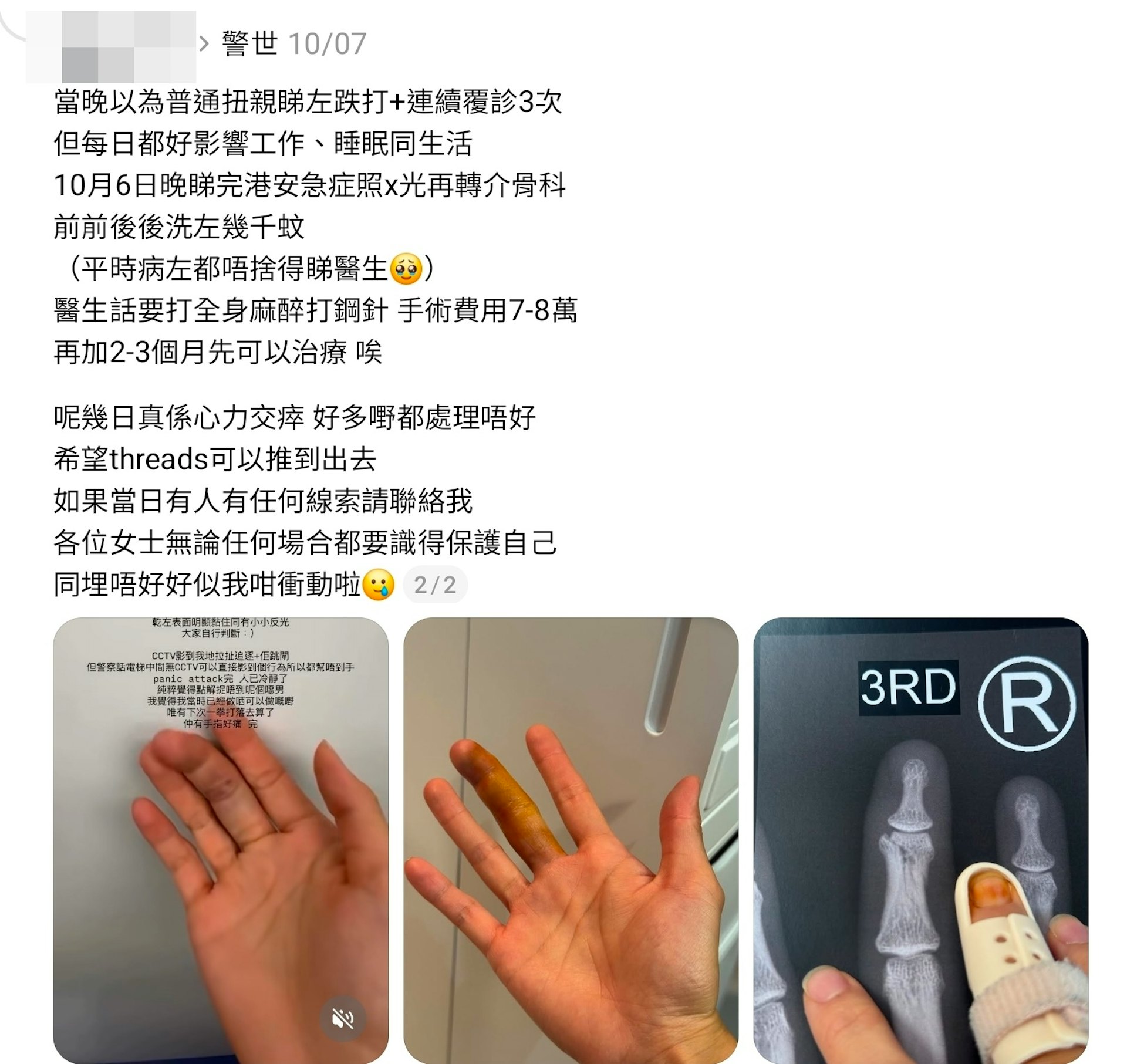 Threads曾流传多段帖文,其中本月初,一名女子称在尖沙咀站被一名男子喷不明液体于脚部,与对方拉扯时弄伤手指,需转介骨科做手术。