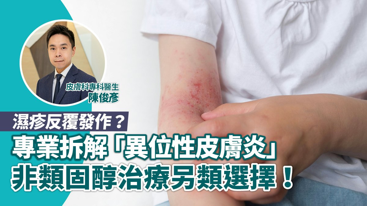 濕疹紓緩皮膚科專科醫生解構異位性皮膚炎與非類固醇治療另類選擇