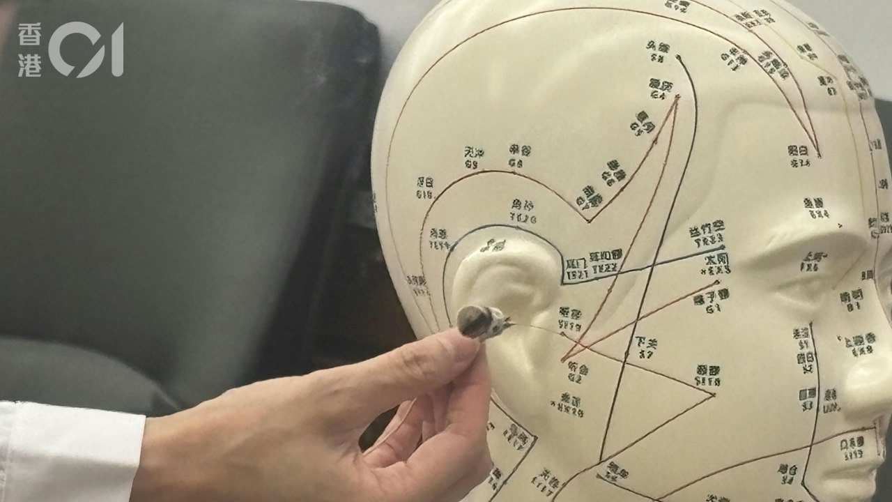 耳鳴患者福音!中大研「電針療法」降耳鳴響度 逾半患者症狀好轉